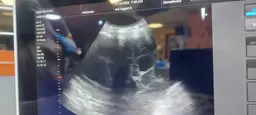 Attractive signs along with presence of pleural effusion
